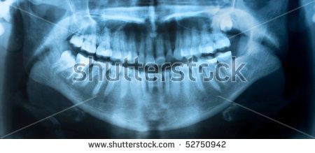 A Panoramic X-ray gives a broad overview of the entire mouth.  is useful in   providing diagnostic information regarding identifiable landmarks, pathology, and 