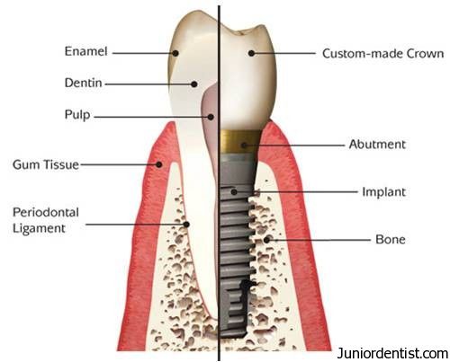Definitions of implantology and implant dentistry; Historical overview; Current   status of dental implants. Classification and Definitions of Dental Implants 