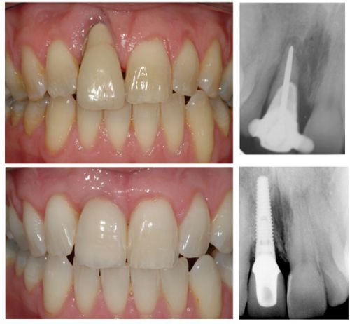 Failing dental implants usually display the clinical characteristics of periodontally   diseased teeth. Progressive bone loss, pocket formation, bleeding upon 