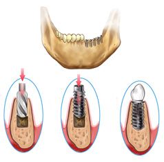 5 Aug 2011  i have a bonding done about 3 yrs agonow the damn thing broke does any one   know a good dentist thats open on saturdaysor at least a 