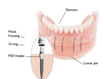 The average cost of mini dental implants is about 60-70% lower than that of   conventional implants. The main reason for this difference is the much lower cost   of 