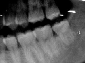 The greater the exposure to X-rays, the greater the risk of cancer.    Overexposure to X-ray radiation can cause welts on the skin resembling burn   blisters.