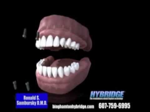 Hybridge Dental Implants - For people with complex dental problems, who are   looking for a simple, attainable, long lasting solution.