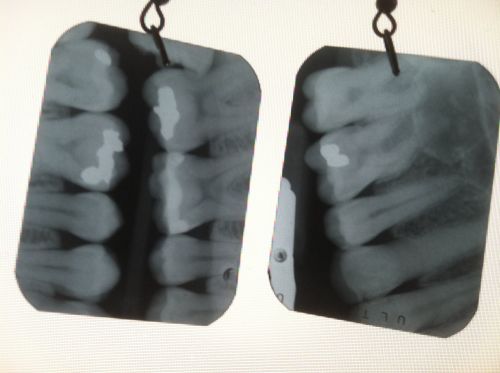 10 Jan 2012  Stand out with these dental x-ray earrings, each pair is unique! No two pairs are   the same. X-rays are about 1.25 in. x 1 in and look great in the 