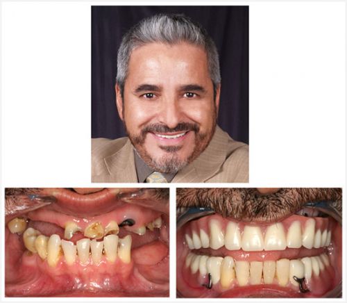 Mini Dental Implants Before and After Pictures by Dr.