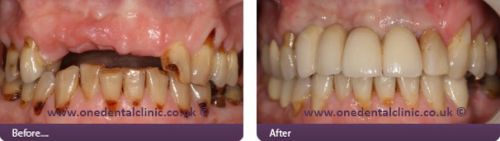 30 Oct 2006  November 3, 2006 at 6:08 am. Advise Please. Its been 7 months since I had 2   dental implants placed. 2 days later im numb and in pain 