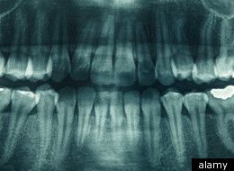 In order to produce skin cancer, exposures in the ranges of thousands of   roentgens are needed. This means that with dental x-rays, there is practically no 