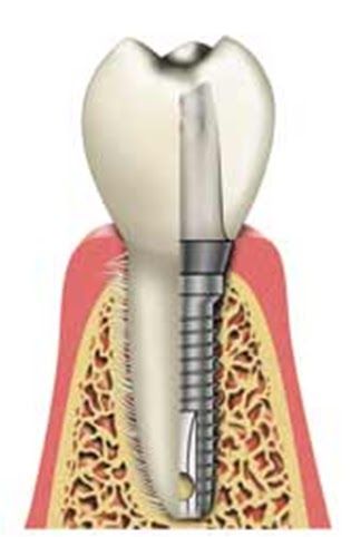 That area of dentistry concerned with the diagnosis, design and insertion of   implant devices and restorations which provides adequate function, comfort and 