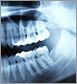 Most routine x-rays are postponed until after birth, but some dental x-rays are  If   dental treatment is needed during the third trimester that is non-emergency 