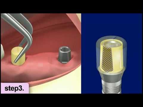 Implant restoration - It takes time for the implant to take hold.  The following   dental implants procedure video shows a live dental implant surgery including a   4 