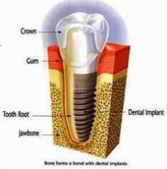 Mini dental implants cost near me