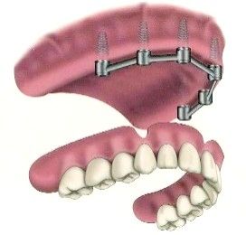 With 6 dental implants in place you can secure an upper denture. With a good    Zest Locator attachments with metal housings shown in picture. You can see 