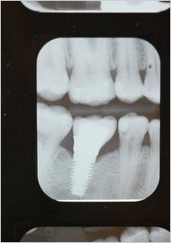 vancouver dentists british columbia bc canada  A dental implant is an artificial   tooth root that is anchored in your jaw to hold a replacement tooth, bridge or 