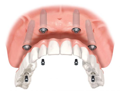What are the pros and cons of the All on 4 Dental implant technique.  2) The   failure of one implant will necessitate replacement and a prosthetic remake.