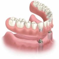 Dental implant supported dentures and overdentures at leading dental implant    Clips or other types of attachments are fitted to the bar the denture, or to both.