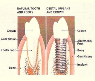 Crown lengthening is a procedure which allows your restoring dentist to perform   a better job in delivering your final restoration. Oftentimes, when a tooth is 