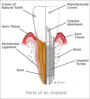 The duration of the whole dental implant procedure varies from patient to patient   and depends, among other things, on the patient's physical condition and 