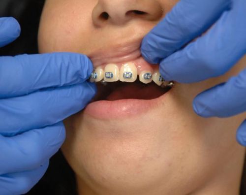 28 Aug 2012  Gretchen Ertl for The New York Times  In about half the states, Medicaid now   covers dental care only for pain relief and emergencies, 