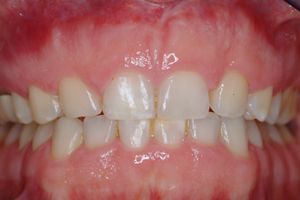 There are two situations in which crown lengthening is commonly performed: to   improve appearance, and to allow a dentist better access to decay. Below is an 
