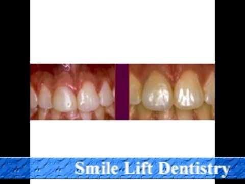 Limestone Dental Associates Dr. David B. Nibouar Dr. Anne P. Annone 5317   Limestone Road Wilmington, Delaware 19808. Phone: 302-239-0502 