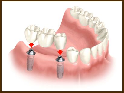 6 Mar 2008  I have a tooth that requires extraction. I've been given the option of replacing the   tooth with a bridge or with an implant. The implant will be a 5.