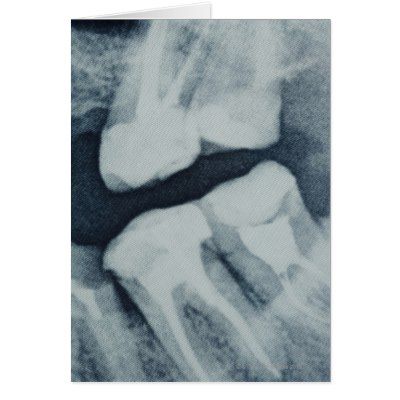 take full responsibility of any undiagnosed interproximal cavities (cavities   between the teeth), any undiagnosed tumors, cysts, or abscessed teeth found in   the 