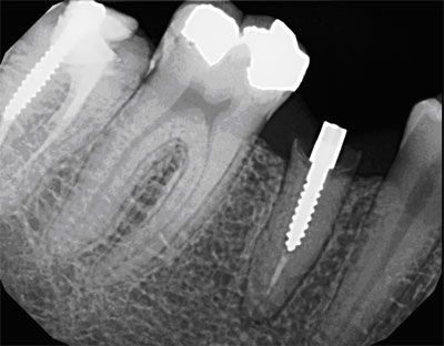 3 Mar 2006  Case Summary. Broken Tooth Crown Bridge Gum Surgery Extractions / Oral   Surgery Dental Implants Teeth: 13,20. Last Full Mouth X-Ray: Jan 