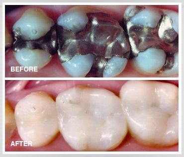 5 Apr 2011  Safe removal of amalgam fillings requires specialized knowledge and proper   precautions. To see the best mercury free dentist in Atlanta call us 