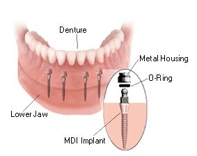 Costs will vary depending on where you live and your specific needs. The cost   will also vary depending on the actual type and number of dental implants used.