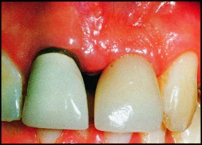 28 Mar 2009  Summary Dental implants have become increasingly common for the   management of tooth .. Oral Maxillofac Implants 1999;14:473e490. 20.