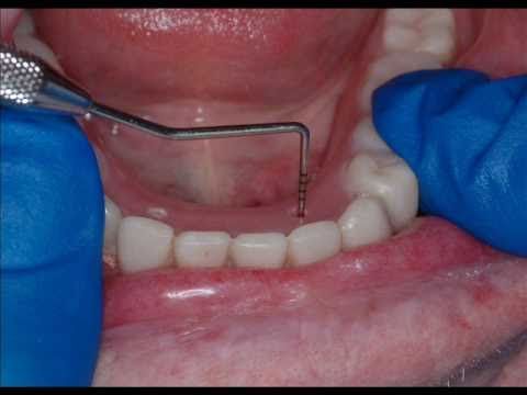 Computer guided dental implant surgery represents a giant step forward in   replacement of teeth with dental implants at no additional cost. All of our implant 
