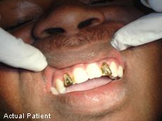 Dentist In Atlanta That Do Gold Teeth – Find Local Dentist Near Your Area
