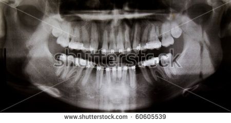  I was asked by representatives from Panoramic Corporation . The relative   movement of the x-ray source and the  tissues, bony and dental landmarks   have 