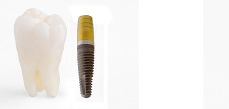 Dental implants are surgically fixed substitutes for roots of missing teeth.   Embedded in the jawbone, . There are basically two types of implants. Those   that are 