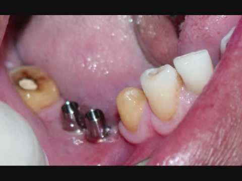 18 May 2012  Dental implants for diabetic patients. Dental implants have brought about a   revolution in the treatment of missing teeth.However, not everybody 