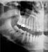 10 Apr 2012  Getting frequent dental X-rays appears to increase the risk for a  for about a   third of all primary brain and central nervous system tumors.