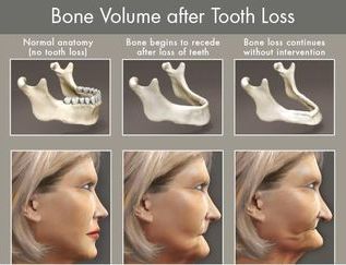 24 Jul 2006  It has been determined that I do need to get implant-supported dentures,  One   plan contemplates the insertion of regular dental implants, while the  Do the   mini dental implants help to prevent bone loss, or are they just to 
