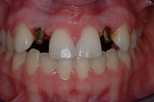 The upper teeth were all removed and 6 dental implants were placed. She was   temporized with an immediate temporary bridge, and following a healing period 