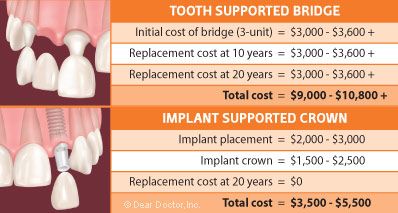 Tooth implant cost delta dental