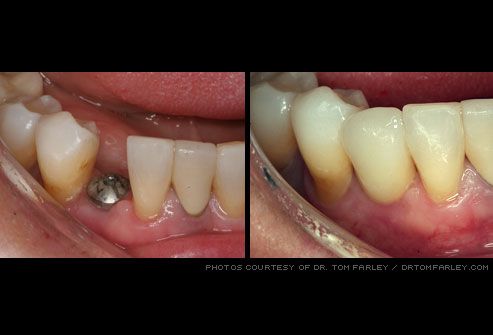 Dental implants going bad failing or failed Austin dentist Corinne Scalziti    before and after photos of treatment plans that closely approximate the current   need.
