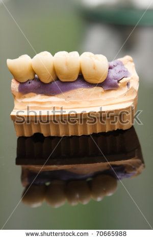 24 Apr 2009  In this article we will compare dental implants and dentures:  complete dentures  , removable partial dentures and implant-retained dentures.