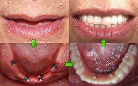 Immediate loading of 2 (all-on-2) versus 4 (all-on-4) implants placed with a   flapless  Restoration Failure; Female; Humans; Immediate Dental Implant   Loading* 