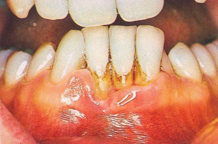 Did you ever wonder what the difference between a good and a bad crown is?    The dentist needs to deliver a perfectly prepared tooth, a perfect mold of that 