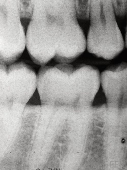 28 Apr 2004  Dental X-rays while pregnant may increase the chance of giving birth to an  We   don't know whether radiation affects neurohormonal 