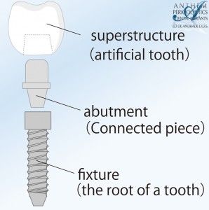 Dental implants have been placed and restored by Dr. Featherstone since 1982.   Only about 1% of  Cost of Single Tooth Dental Implants. 1. . Las Vegas, NV 