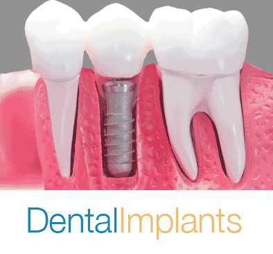 Browse by Dental Procedures: Dental Implant Surgery Implant Supported   Crowns, Bridges & Dentures Other Implant Services Cost of Dental Implants -   Russia, 
