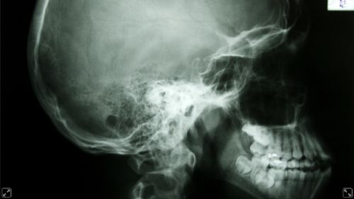 10 Apr 2012  Certain kinds of dental X-rays appear to be correlated with a type of brain tumor   — one that's almost always benign, but can still be dangerous 