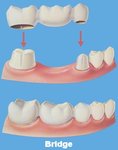 Care of your dental bridge changes somewhat depending on whether yours is a    This cost can drop by 60-80% if you choose India, Thailand, Mexico, Costa 