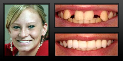 2 May 2012  Two to six implants topped with a partial or full-mouth dental bridge can cost   $3,500-$30,000 or more, depending on the number of implants, 