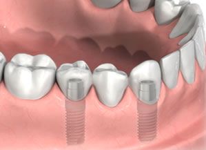 Dental implants are artificial tooth roots placed in the jaw to hold a replacement   tooth or bridge for those who have lost a tooth or teeth.
